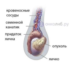 Как определить опухоль от придатка яичка