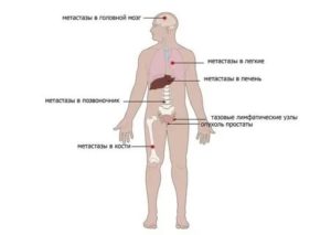 Метастазы в почки при раке предстательной железы