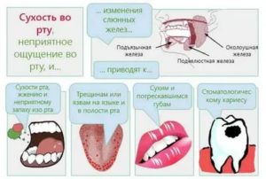 Сухость во рту при раке простаты