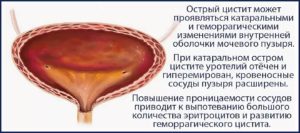 Что такое геморрагический цистит причины заболевания