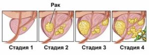 Рак простаты по синельникову
