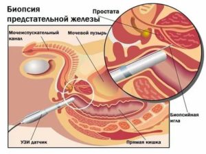 Как подготовиться к пункции предстательной железы