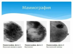 Когда можно делать маммографию после операции на молочной железе