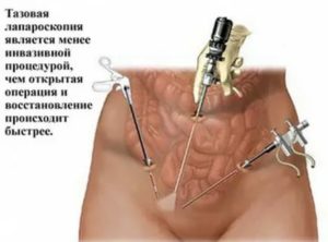 Жанин после лапароскопии эндометриоза