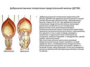 Лечение грибами аденомы предстательной железы