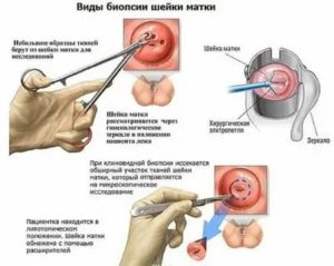 Может ли биопсия быть ошибочной при раке шейки матки