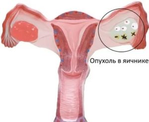 Почему нет месячных в 44 года причины