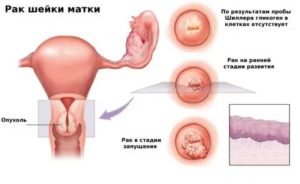 Что значит распад опухоли при раке шейки матки