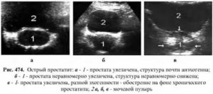 Предстательная железа эхоструктура неоднородная контур четкий
