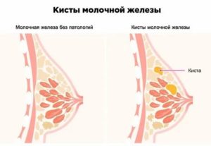 Может ли при климаксе болеть соски на груди