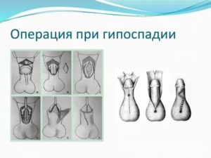 Можно ли избежать операции при гипоспадии