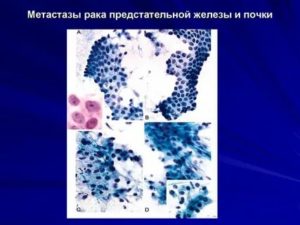 Метастазы в почки при раке предстательной железы