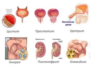 Может ли цистит или пиелонефрит передаваться половым путем