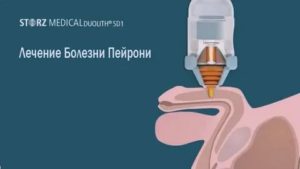 Можно ли вылечить болезнь пейрони без операции