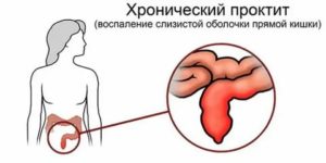 Чем лечить гонококковый проктит