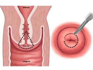 Почему после конизации шейки матки долго идут месячные что