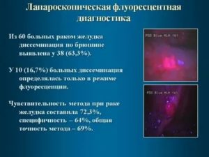 Что такое флуоресцентная диагностика матки