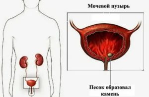 Как отличить песок в мочевом пузыре от цистита