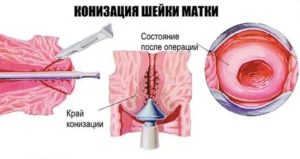 Сколько по времени делают операцию на шейки матки