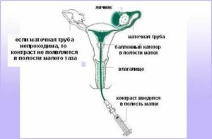 На какой день цикла проверяют проходимость маточных труб на узи