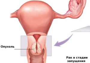Как убрать опухоль с влагалища