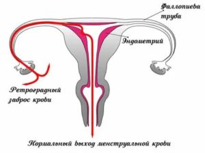 Что такое ретроградными менструациями