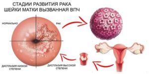 Может ли впч вызвать простатит