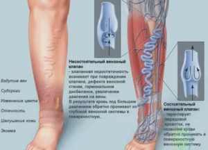 Могут ли болеть вены на ногах при месячных