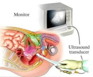 Оптимальным методом для узи предстательной железы является