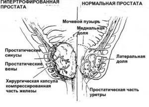 Рост латеральных долей предстательной железы