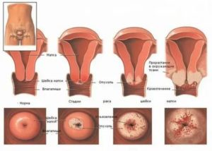 Как уменьшить выделения при раке матки