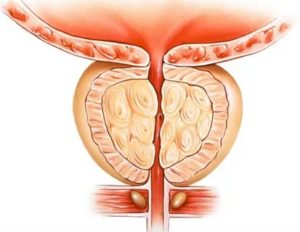 Как лечить аденому простаты по методу шевченко