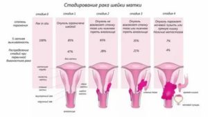 К чему приснилось что у меня рак матки