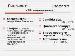 Как лечить стоматит при вич инфекции