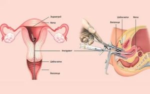 Раздельное диагностическое выскабливание при эндометриозе