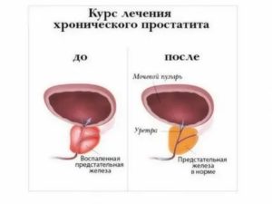 Лечение вялотекущего хронического простатита