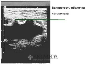 Узи заключение молочной железы с имплантами