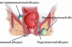 Может при цистите боль отдавать в прямую кишку