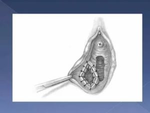 Что такое марсупиализация кисты бартолиновой железы отзывы