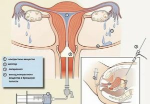 Лапароскопия для диагностики проходимости маточных труб