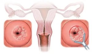 Что такое кольпоцитология шейки матки