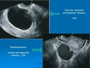 Как выглядит цистаденома яичника на узи