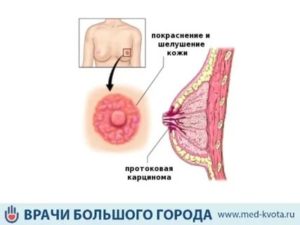 Кровь из соска при раке молочной железы