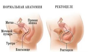 Где делают операцию при цистоцеле