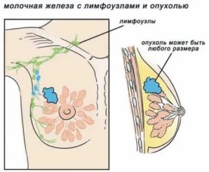 Что за приливы при раке молочной железы