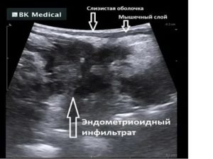 Когда лучше делать узи при подозрении на эндометриоз