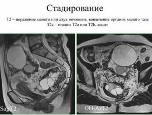 Можно ли на мрт увидеть рак яичников