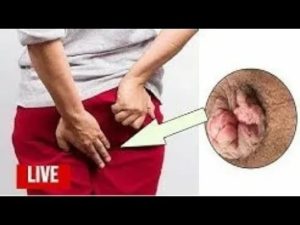 Можно ли заболеть циститом после анального секса