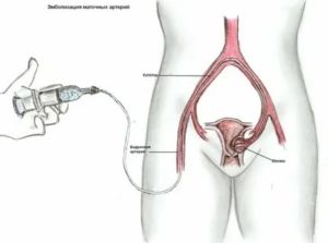 Эмболизация маточных артерий при раке шейки матки как делать