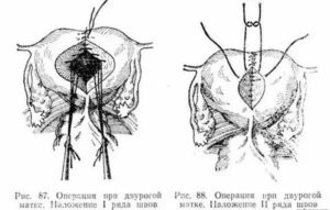 Как называется операция двурогой матки